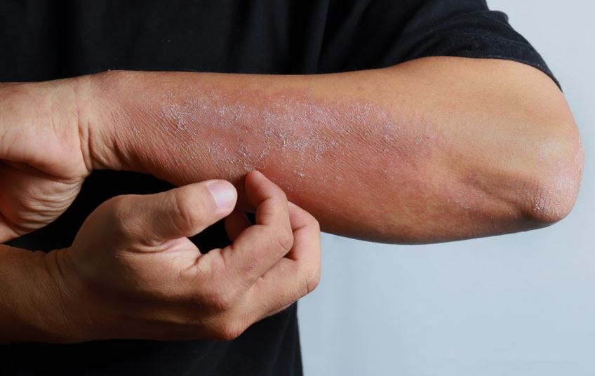 skin disease